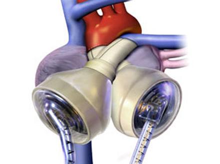 artificial-heart.jpg