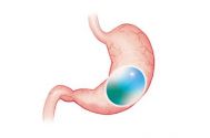 Chirurgia fără chirurgie un balon gastric non-invaziv şi 100% natural, capabil să reducă pofta de mâncare