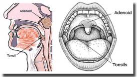 Voceaconstantei.ro Adeno-amigdalita acută la copii