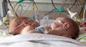 Vești noi despre siamezele născute la Constanța