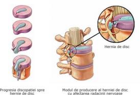 Voceaconstantei.ro Hernia de disc, cauze şi tratament