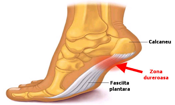 Durerile de calcai – cauze si tratament nechirurgical