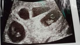 O tânără de 18 ani este însărcinată a doua oară. O ecografie i-a oferit însă surpriza vieții!