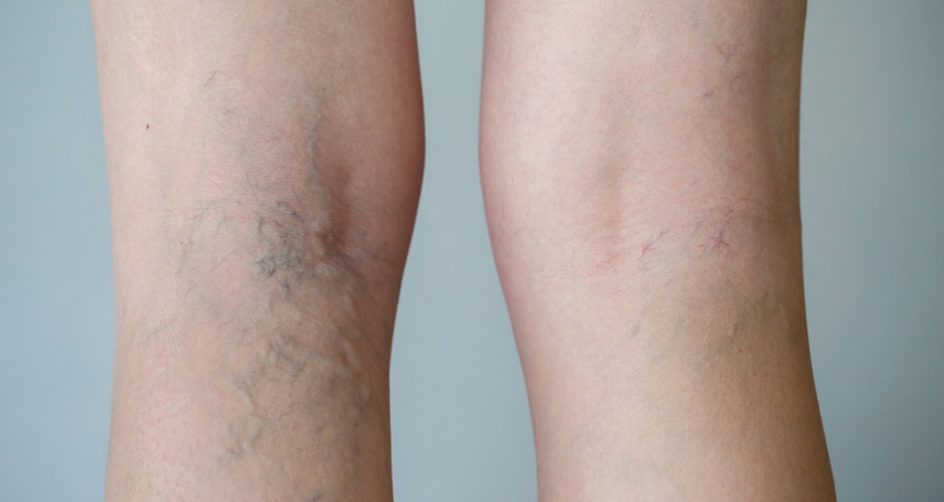 Eczema pe picioare cu varice foto