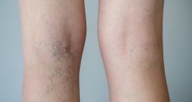 Cum recunoaştem simptomele apariţiei varicelor? Tipologii ale bolii