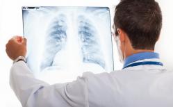 Cancerul pulmonar - principala cauză de deces în lume
