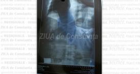 Constanța, în topul județelor în ceea ce privește bolnavii de tuberculoză