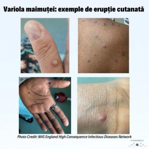 Un nou caz de variola maimuței a fost diagnosticat în România